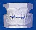 歯列の模型の写真