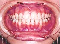 歯列矯正後の写真